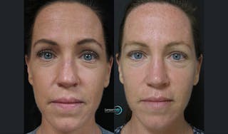 Rhinoplasty Before & After Gallery - Patient 123816179 - Image 2