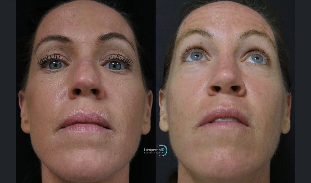 Rhinoplasty Before & After Gallery - Patient 123816179 - Image 3