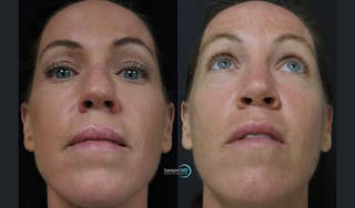Rhinoplasty Before & After Gallery - Patient 123816179 - Image 3