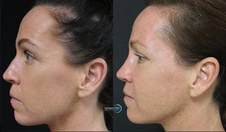 Nasal Fracture Before & After Gallery - Patient 122908663 - Image 4