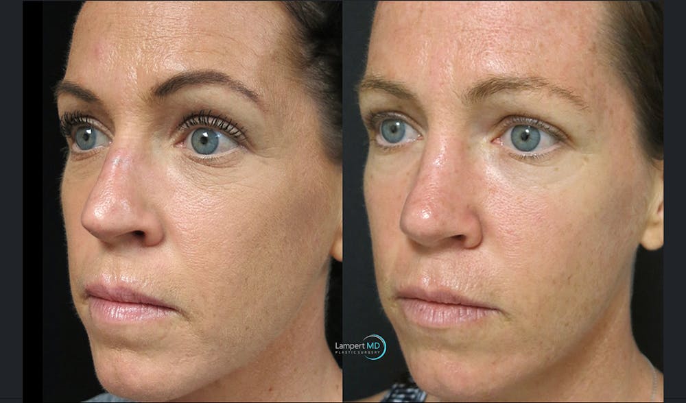 Rhinoplasty Before & After Gallery - Patient 123816179 - Image 5