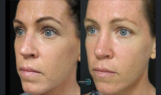 Rhinoplasty Before & After Gallery - Patient 123816179 - Image 5