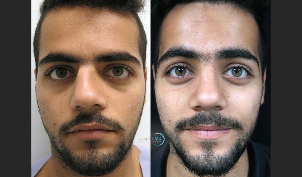 Rhinoplasty Before & After Gallery - Patient 123816180 - Image 1