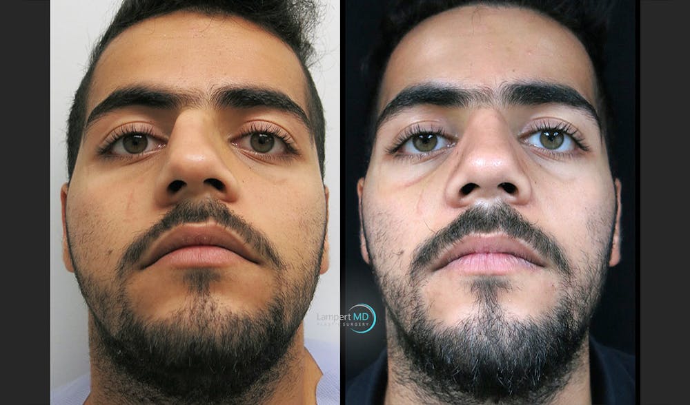Rhinoplasty Before & After Gallery - Patient 123816180 - Image 2