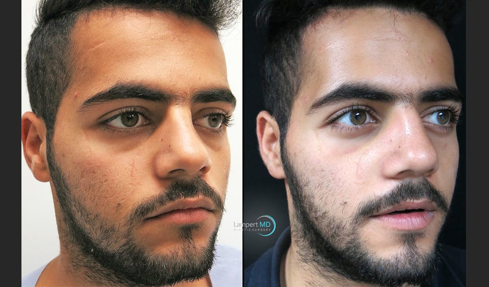 Rhinoplasty Before & After Gallery - Patient 123816180 - Image 3