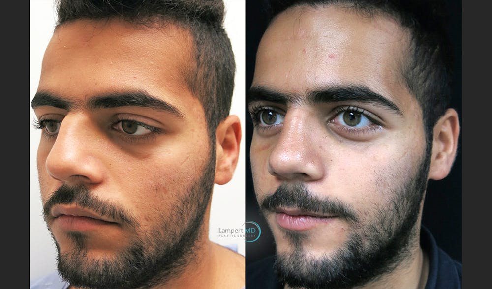 Rhinoplasty Before & After Gallery - Patient 123816180 - Image 4