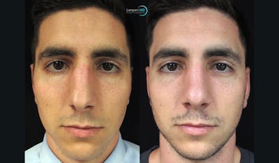 Rhinoplasty Before & After Gallery - Patient 123816183 - Image 1