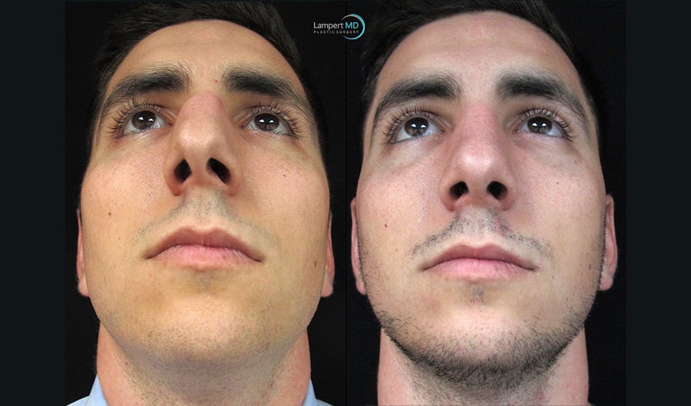 Nasal Fracture Before & After Gallery - Patient 122908654 - Image 2