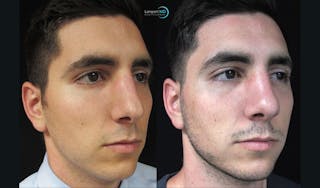 Nasal Fracture Before & After Gallery - Patient 122908654 - Image 3