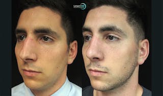 Rhinoplasty Before & After Gallery - Patient 123816183 - Image 2