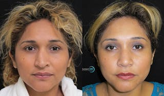 Rhinoplasty Before & After Gallery - Patient 123816185 - Image 1
