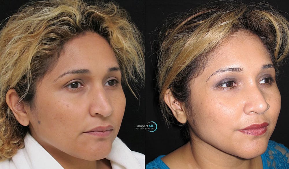 Rhinoplasty Before & After Gallery - Patient 123816185 - Image 2