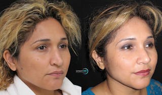 Rhinoplasty Before & After Gallery - Patient 123816185 - Image 2