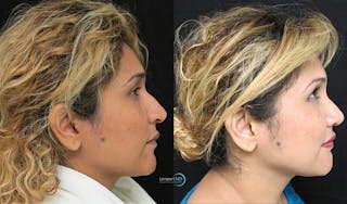 Rhinoplasty Before & After Gallery - Patient 123816185 - Image 3