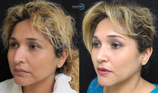 Rhinoplasty Before & After Gallery - Patient 123816185 - Image 4