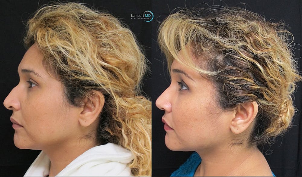 Rhinoplasty Before & After Gallery - Patient 123816185 - Image 5
