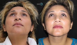 Rhinoplasty Before & After Gallery - Patient 123816185 - Image 6