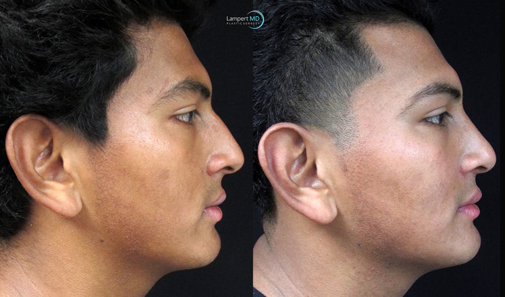Rhinoplasty Before & After Gallery - Patient 123816187 - Image 1