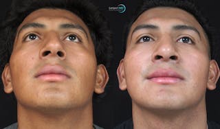 Nasal Fracture Before & After Gallery - Patient 122908660 - Image 3
