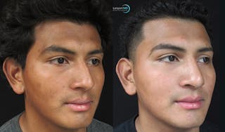Rhinoplasty Before & After Gallery - Patient 123816187 - Image 3