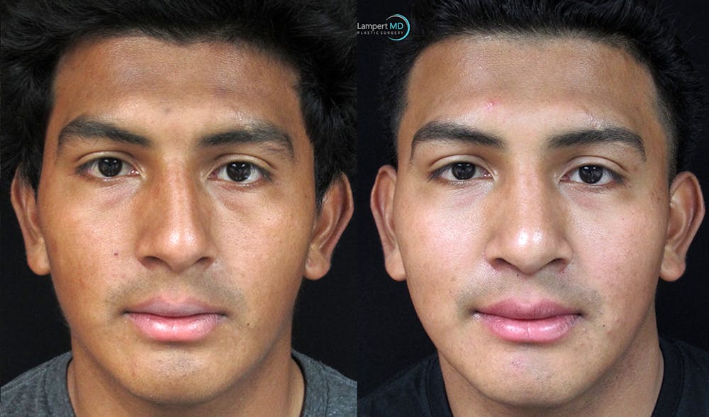 Rhinoplasty Before & After Gallery - Patient 123816187 - Image 4