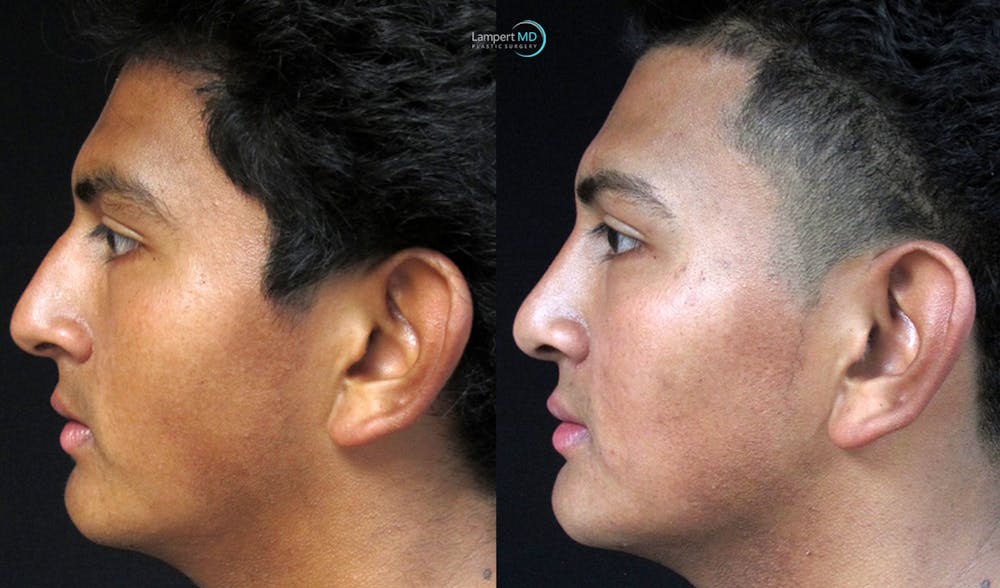 Nasal Fracture Before & After Gallery - Patient 122908660 - Image 5