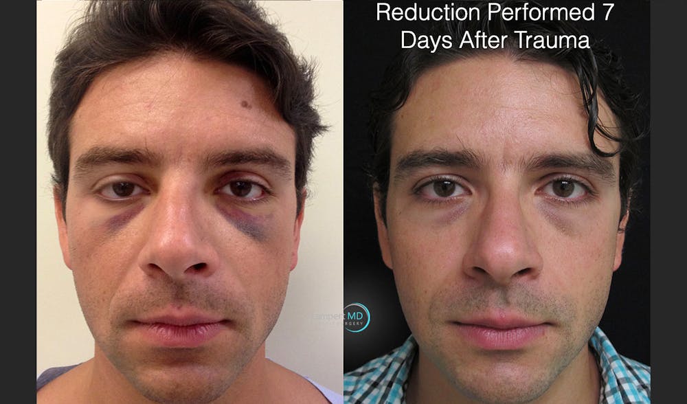 Rhinoplasty Before & After Gallery - Patient 123816214 - Image 1