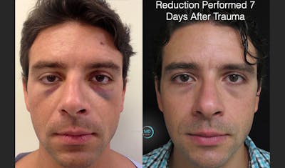 Nasal Fracture Before & After Gallery - Patient 122908676 - Image 1