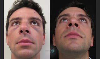 Nasal Fracture Before & After Gallery - Patient 122908676 - Image 2