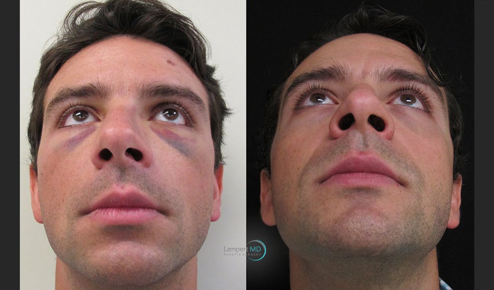 Nasal Fracture Before & After Gallery - Patient 122908676 - Image 2