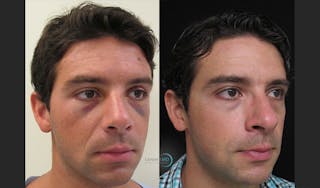 Rhinoplasty Before & After Gallery - Patient 123816214 - Image 3
