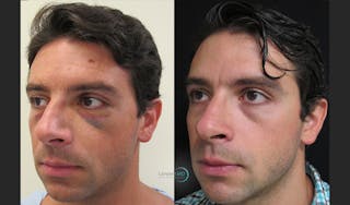 Rhinoplasty Before & After Gallery - Patient 123816214 - Image 4