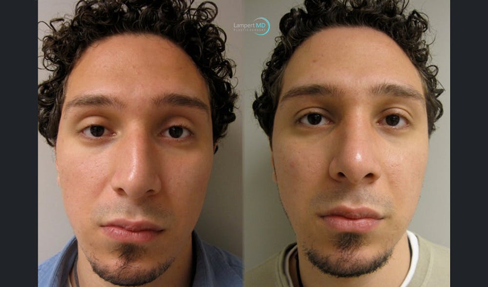 Rhinoplasty Before & After Gallery - Patient 148352812 - Image 1