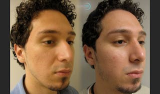 Nasal Fracture Before & After Gallery - Patient 144711792 - Image 2