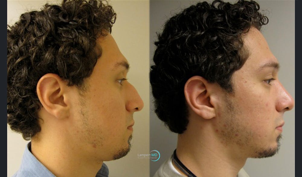 Nasal Fracture Before & After Gallery - Patient 144711792 - Image 3