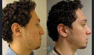 Nasal Fracture Before & After Gallery - Patient 144711792 - Image 3