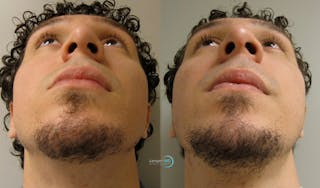 Rhinoplasty Before & After Gallery - Patient 148352812 - Image 4