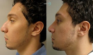 Nasal Fracture Before & After Gallery - Patient 144711792 - Image 5