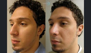 Rhinoplasty Before & After Gallery - Patient 123816240 - Image 6
