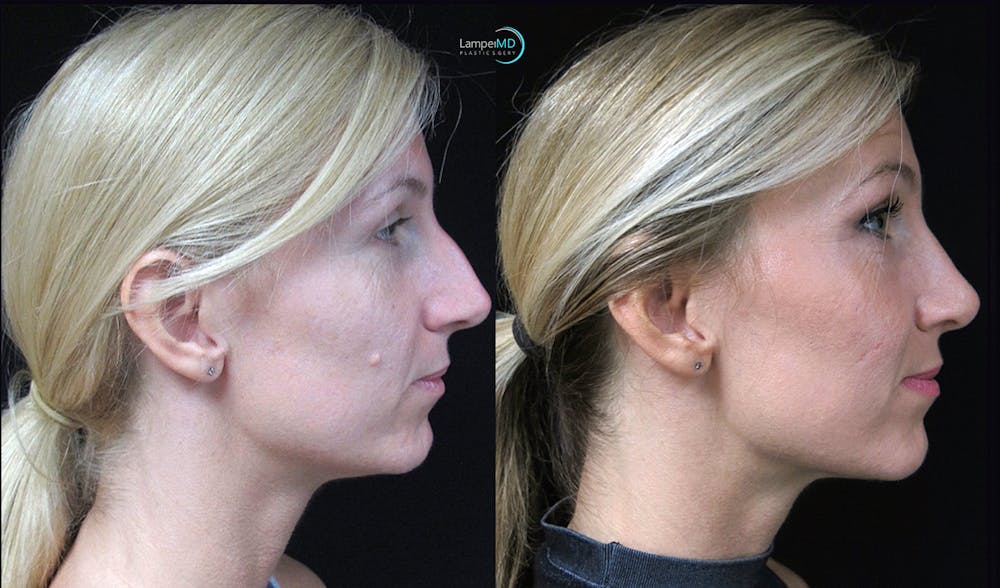 Rhinoplasty Before & After Gallery - Patient 123816092 - Image 5