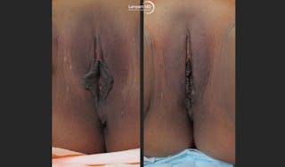 Labiaplasty Before & After Gallery - Patient 142681659 - Image 1