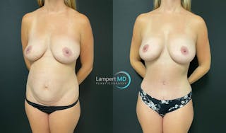 Tummy Tuck Before & After Gallery - Patient 142815678 - Image 2