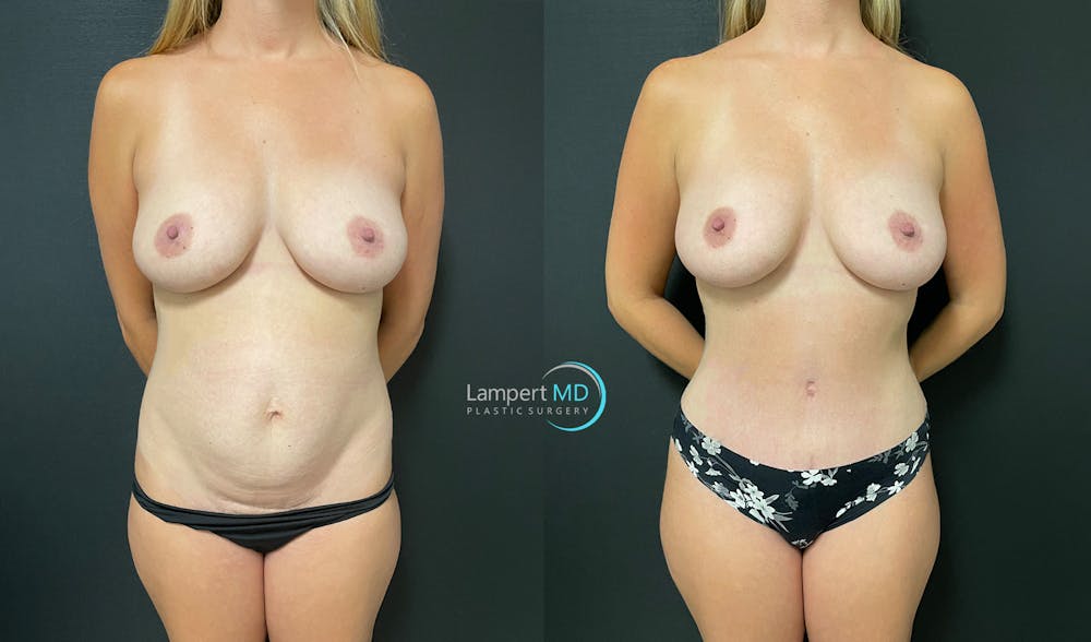 Mommy Makeover Before & After Gallery - Patient 143556266 - Image 1