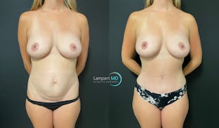 Tummy Tuck Before & After Gallery - Patient 142815678 - Image 1