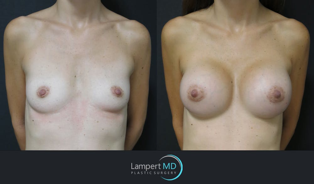 Breast Augmentation Before & After Gallery - Patient 143555840 - Image 1