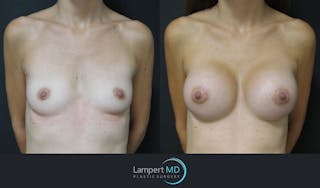 Breast Augmentation Before & After Gallery - Patient 143555840 - Image 1