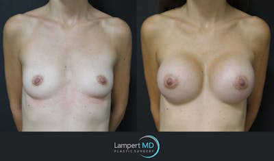 Breast Augmentation Before & After Gallery - Patient 143555840 - Image 1