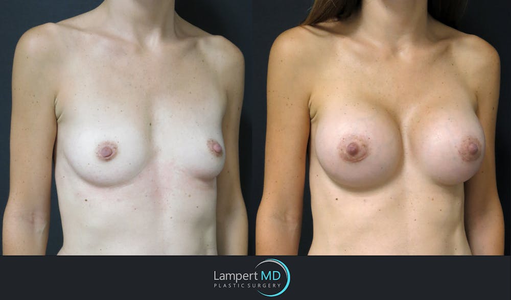 Breast Augmentation Before & After Gallery - Patient 143555840 - Image 2