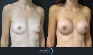 Breast Augmentation Before & After Gallery - Patient 143555840 - Image 2