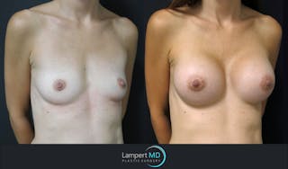 Breast Augmentation Before & After Gallery - Patient 143555840 - Image 3